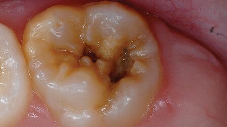 TOOTH DECAY